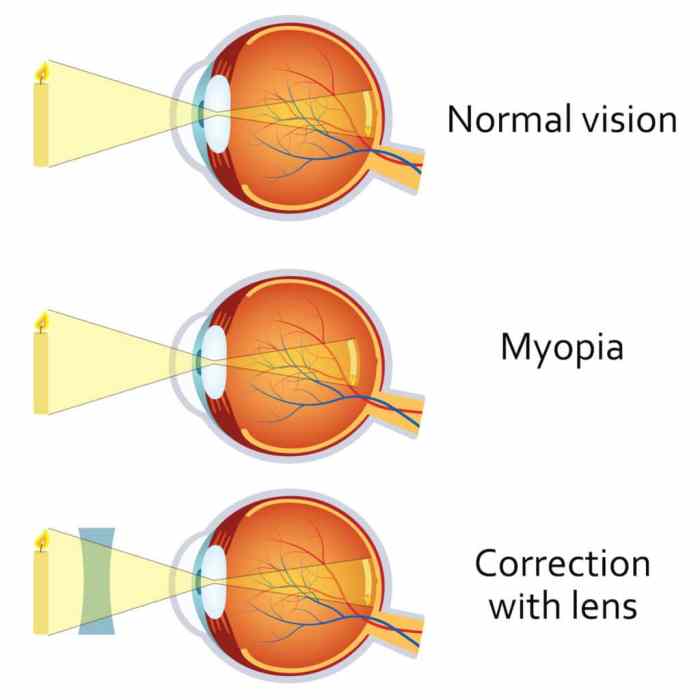 Myopia definition lord of the flies