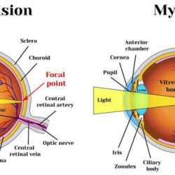 Myopia definition lord of the flies